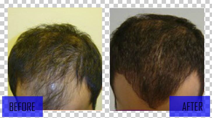 Hair Transplantation Hair Loss Wig Black Hair PNG, Clipart, Black Hair, Brown Hair, Chatham County Georgia, Chin, Dutasteride Free PNG Download