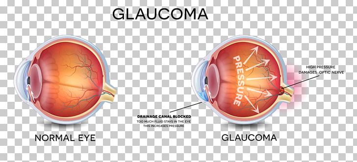 Glaucoma Vision Loss Eye Examination Eye Care Professional PNG, Clipart, Disease, Eye, Eye Care Professional, Eye Drops Lubricants, Eye Examination Free PNG Download