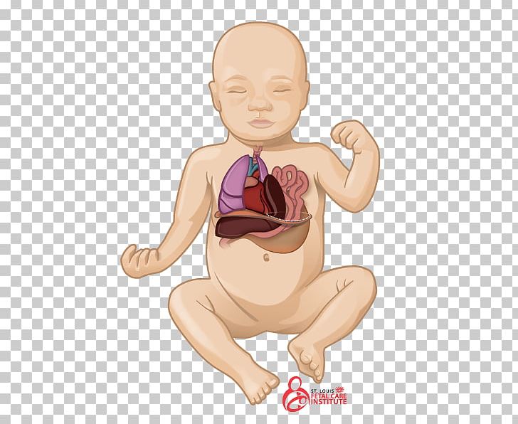 Pulmonary Hypoplasia Congenital Pulmonary Airway Malformation Congenital Diaphragmatic Hernia Lung PNG, Clipart, Abdomen, Arm, Baby, Birth Defect, Cdh Free PNG Download