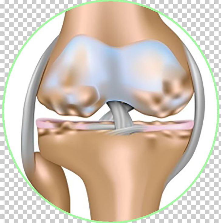 Osteoarthritis Joint Effusion Knee Effusion PNG, Clipart, Arthritis, Arthropathy, Bone, Bursitis, Cheek Free PNG Download