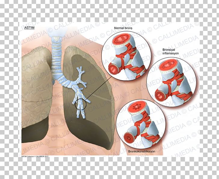 Asthma Lung Bronchus Respiratory Tract PNG, Clipart, Asma, Asthma, Bronchus, Download, Email Free PNG Download