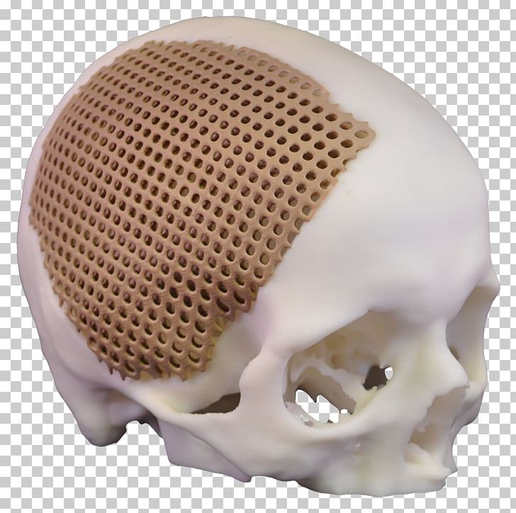 Xilloc Skull Bone Implant Jaw PNG, Clipart, Bone, Complex, Computed Tomography, Cooperation, Dental Implant Free PNG Download