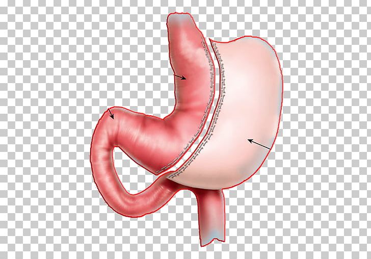 Sleeve Gastrectomy Gastric Bypass Surgery Adjustable Gastric Band Bariatric Surgery PNG, Clipart, Adjustable Gastric Band, Apk, Arm, Bariatrics, Bariatric Surgery Free PNG Download