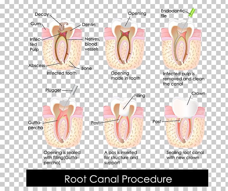 Endodontic Therapy Root Canal Dentistry Crown PNG, Clipart, Crown, Dental Restoration, Dentist, Dentistry, Endodontic Files And Reamers Free PNG Download