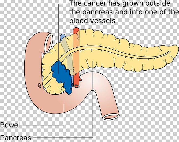 Pancreatic Cancer Pancreas Disease Death PNG, Clipart, Angle, Area, Cancer, Cartoon, Death Free PNG Download