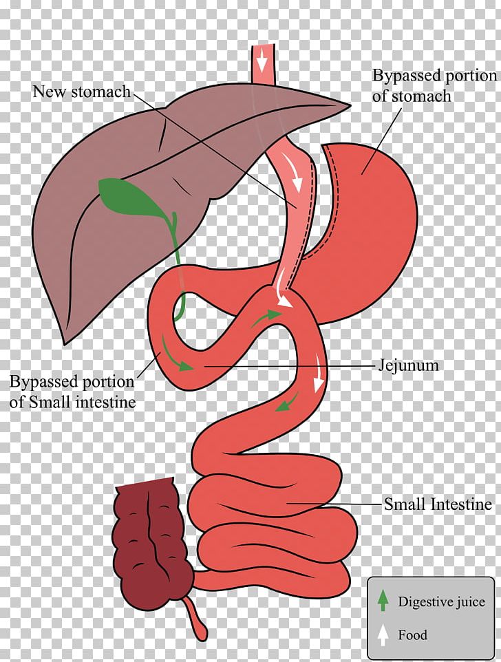 Sleeve Gastrectomy Gastric Bypass Surgery Duodenal Switch Bariatric Surgery PNG, Clipart, Adjustable Gastric Band, Angle, Arm, Bariatric, Bariatric Surgery Free PNG Download
