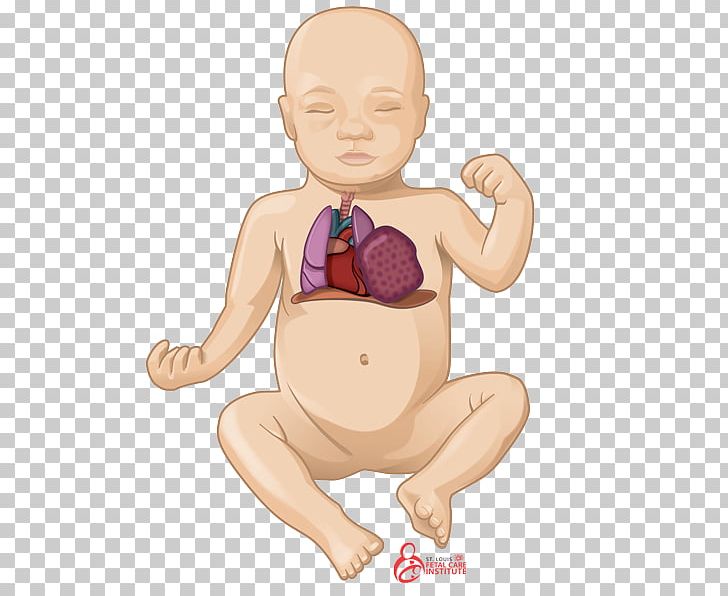 Pulmonary Hypoplasia Lung Congenital Pulmonary Airway Malformation Pulmonary Sequestration PNG, Clipart, Anatomy, Arm, Child, Childbirth, Fictional Character Free PNG Download