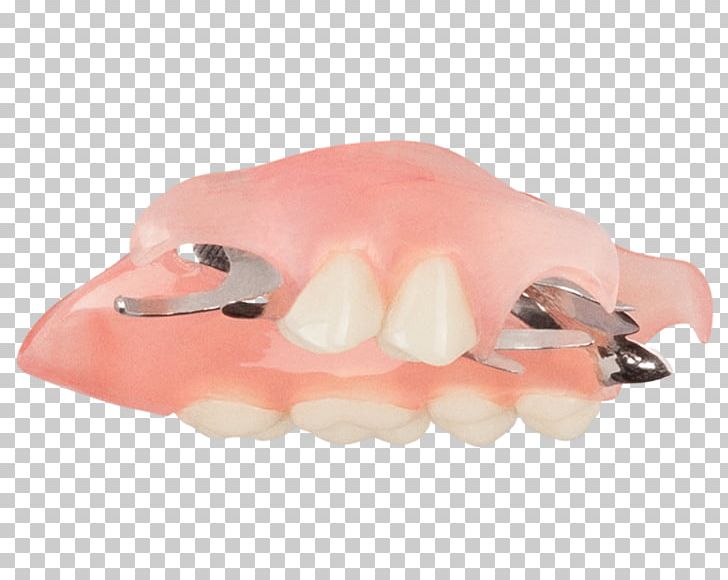 Tooth Dentures Removable Partial Denture Dentistry Crown PNG, Clipart, Aspen Dental, Blog, Creative Commons License, Crown, Dentistry Free PNG Download