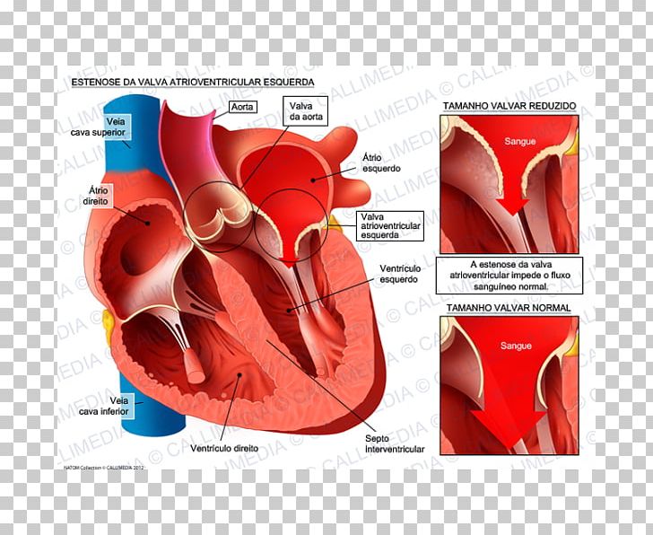Aortic Insufficiency Aorta Aortic Stenosis Ventricle Aortic Valve PNG, Clipart, 3d Head, Aorta, Aortic Insufficiency, Aortic Stenosis, Aortic Valve Free PNG Download