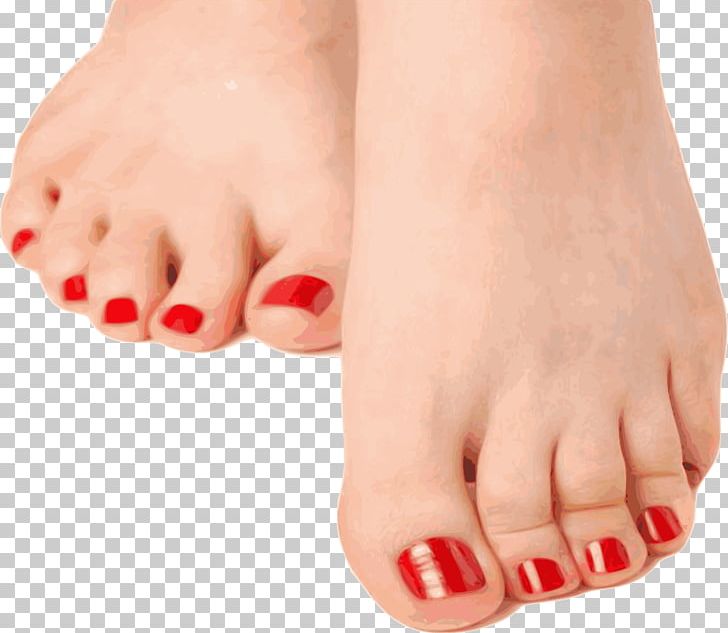 Hammer Toe Nail Foot Onychomycosis PNG, Clipart, Athletes Foot, Finger, Foot, Hammer Toe, Hand Free PNG Download