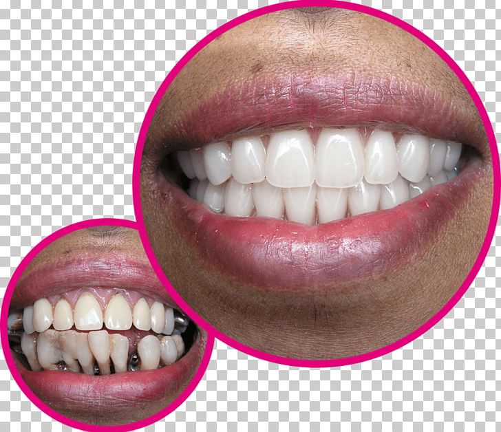 Tooth Gebiss Dentist Dentures Implant PNG, Clipart, Chin, Cosmetic Dentistry, Dentist, Dentures, Drawing Free PNG Download