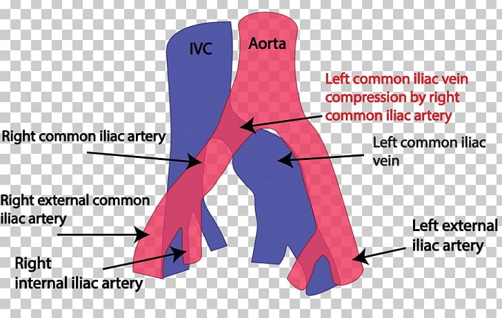 Common Iliac Vein May–Thurner Syndrome Common Iliac Artery Iliofemoral Ligament PNG, Clipart, Angle, Area, Arm, Artery, Common Iliac Artery Free PNG Download