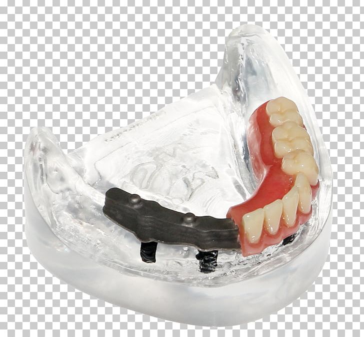 Dentures Prosthesis Tooth Bar Dentistry PNG, Clipart, Architectural Engineering, Bar, Core, Dental Technician, Dentistry Free PNG Download
