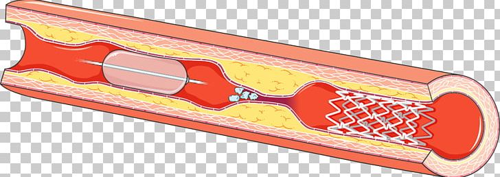 Pharmaceutical Drug Angioplasty Servier Medical Drug-eluting Stent PNG, Clipart, Angioplasty, Angle, Art, Arteriosclerosis, Cardiovascular System Free PNG Download