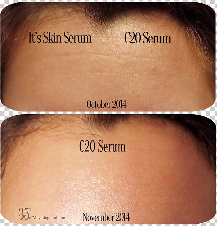 Wrinkle Vitamin C Serum Skin PNG, Clipart, Acne, Antiaging Cream, Cheek, Chin, Closeup Free PNG Download