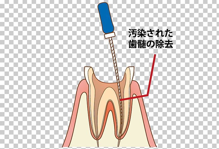 Tooth Dentist 歯科 Endodontic Therapy Root Canal PNG, Clipart, Ache, Angle, Arm, Dental Implant, Dentist Free PNG Download