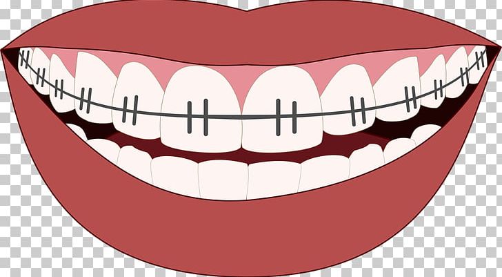 Cosmetic Dentistry Orthodontics Dental Implant PNG, Clipart, Cheek, Child, Chin, Cosmetic Dentistry, Crown Free PNG Download