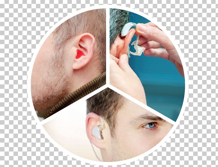 Endoscopic Ear Surgery Hearing Middle Ear Inner Ear PNG, Clipart, 3shape, Auricle, Cheek, Chin, Divider Material Free PNG Download