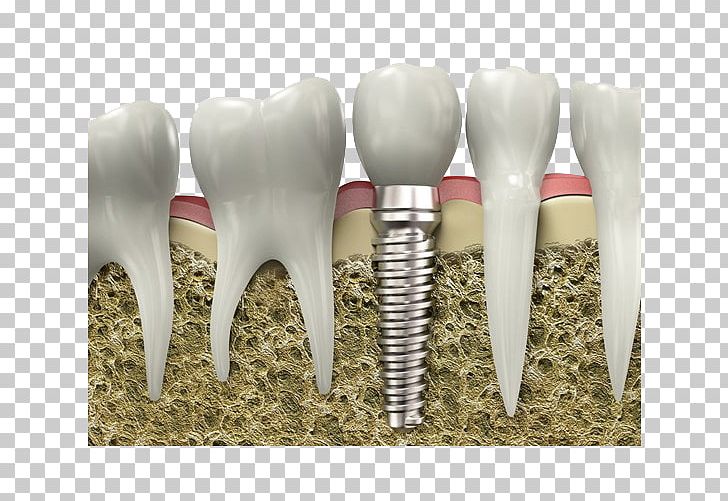 Dentistry Dental Implant Dental Surgery Tooth PNG, Clipart, Bridge, Care, Cosmetic Dentistry, Crop, Crown Free PNG Download