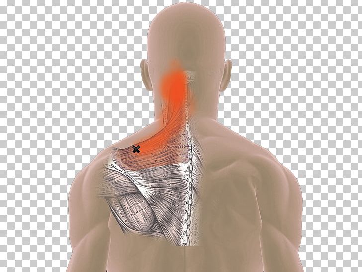Neck Pain Myofascial Trigger Point Trapezius Muscle Spasm PNG, Clipart, Arm, Back Pain, Beak, Finger, Human Back Free PNG Download