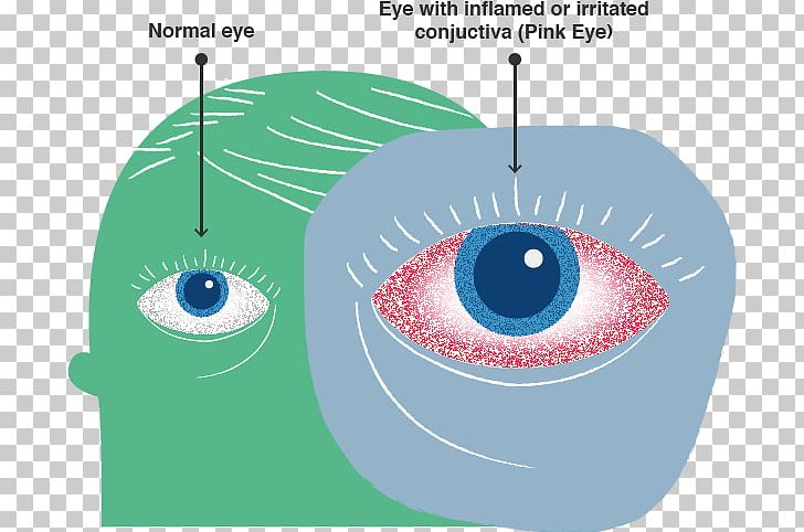 Eye Allergic Conjunctivitis Centers For Disease Control And Prevention Allergy PNG, Clipart, Allergy, Circle, Conjunctivitis, Diagram, Eye Free PNG Download
