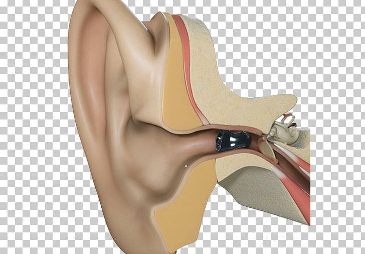 Hearing Aid Starkey Laboratories Ear Canal PNG, Clipart, Aids, Arm, Audiology, Auricle, Cat Ear Free PNG Download
