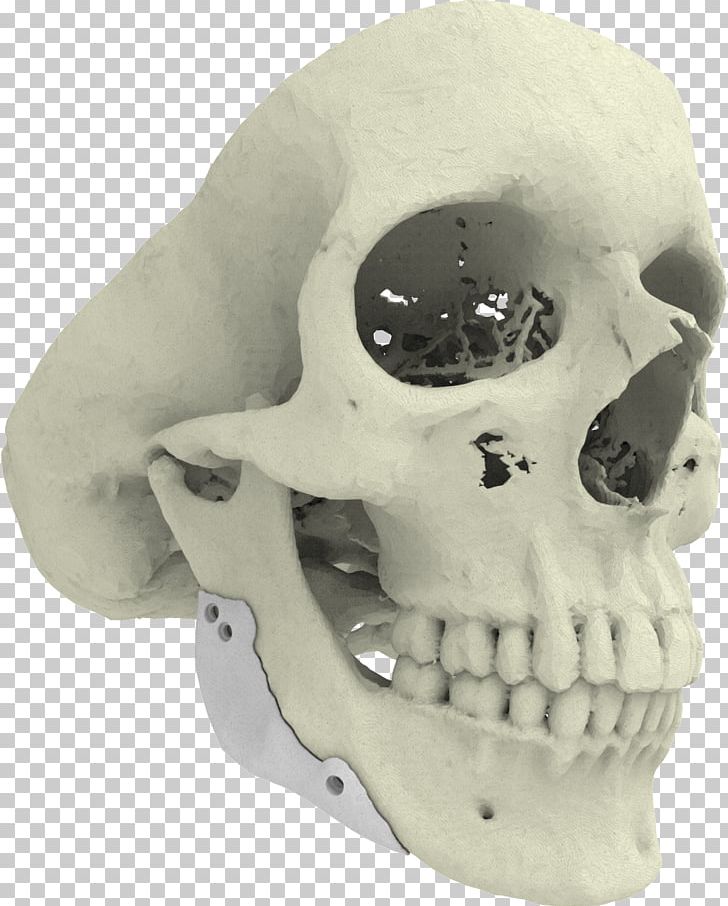 3D Printing Implant Xilloc Bone PNG, Clipart, 3 D, 3 D Printer, 3d Printing, Augmentation, Bone Free PNG Download