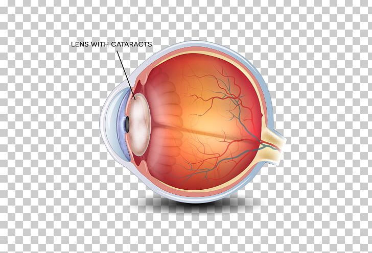 Cataract Surgery Ophthalmology Lens Eye Care Professional PNG, Clipart, Blurred Vision, Cataract, Cataract Surgery, Diabetic Retinopathy, Dry Eye Syndrome Free PNG Download