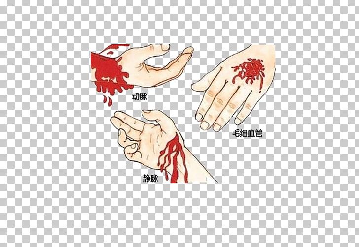 Emergency Bleeding Control First Aid Medical Sign Wound PNG, Clipart, Amount, Arm, Artery, Auto Parts, Bleeding Free PNG Download