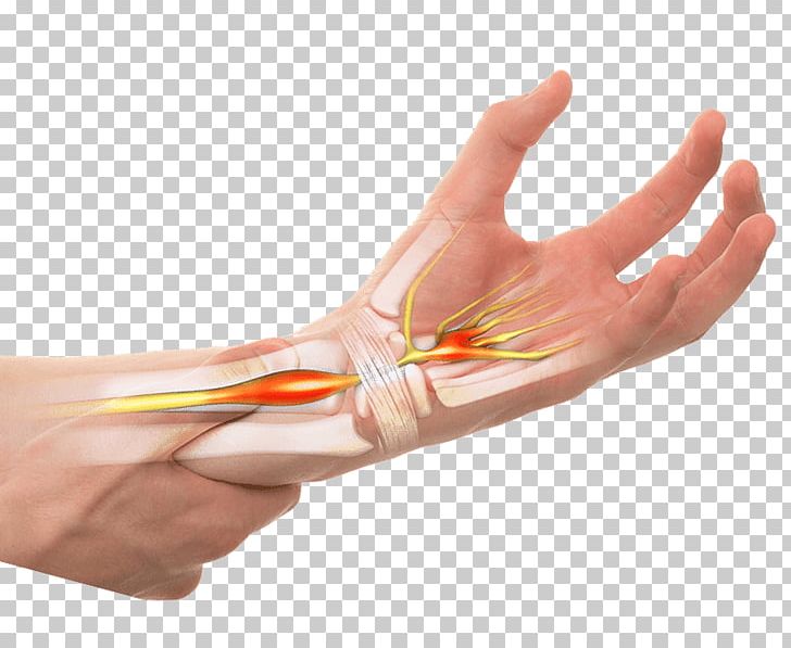 Thumb Carpal Tunnel Syndrome Symptom PNG, Clipart, Ache, Arm, Carpal Bones, Carpal Tunnel, Carpal Tunnel Syndrome Free PNG Download
