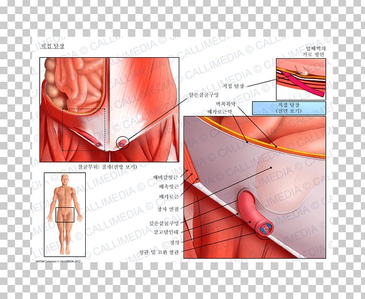 Inguinal Hernia Abdominal External Oblique Muscle Inguinal Canal Anatomy PNG, Clipart, Abdomen, Abdominal External Oblique Muscle, Abdominal Hernia, Abdominal Internal Oblique Muscle, Anatomy Free PNG Download