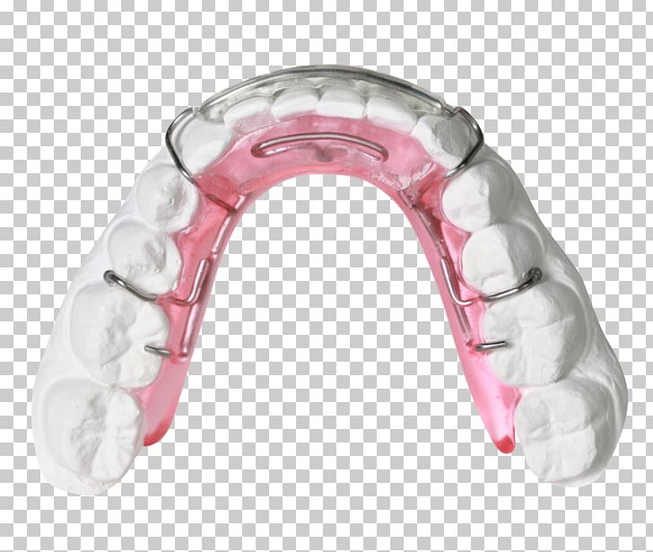 Clear Aligners Orthodontics Orthodontic Technology Jaw Bionator PNG, Clipart, Bionator, Clear Aligners, Crib, David Gergen, Dentistry Free PNG Download
