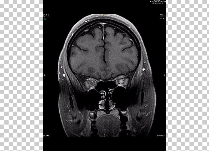 Skull Medical Radiography Computed Tomography Medicine Brain PNG, Clipart, Black And White, Blurred, Bone, Brain, Cervical Vertebrae Free PNG Download