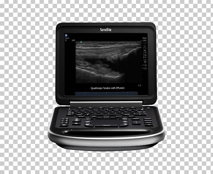 Ultrasonography Ultrasound SonoSite PNG, Clipart, Bildgebendes Verfahren, Diagnose, Display Device, Electronic Device, Electronics Free PNG Download