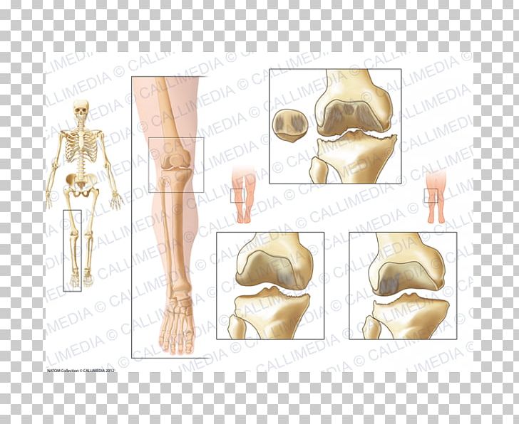 La Gonarthrose Knee Osteoarthritis Knee Osteoarthritis Knee Arthritis PNG, Clipart, Abdomen, Arm, Arthritis, Bone, Ear Free PNG Download