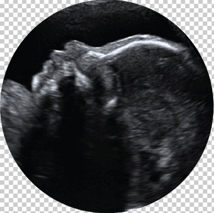 3D Ultrasound Ultrasonography Pregnancy Infant PNG, Clipart, 3d Ultrasound, Amniotic Fluid, Black And White, Childbirth, Embryo Free PNG Download