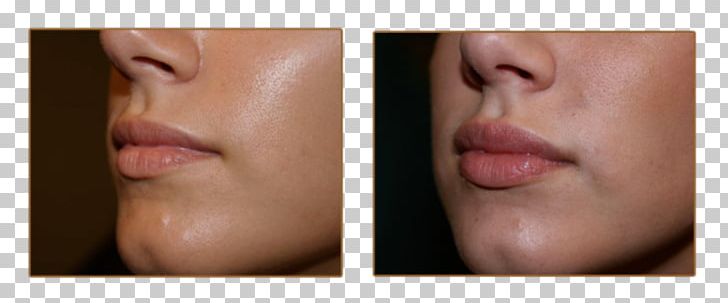 Lip Augmentation Injectable Filler Juvéderm Cheek PNG, Clipart, Cheek, Chin, Closeup, Dermis, Dimple Free PNG Download