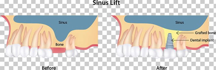 Sinus Lift Dental Implant Dentist Surgery PNG, Clipart, Angle, Area, Bone, Bone Grafting, Brand Free PNG Download