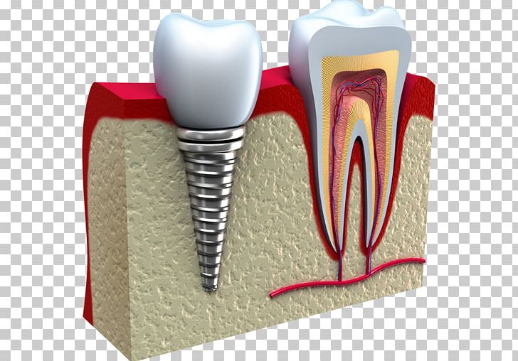 Dental Implant Cosmetic Dentistry PNG, Clipart, Chewing, Cosmetic Dentistry, Crown, Dental Implant, Dental Restoration Free PNG Download