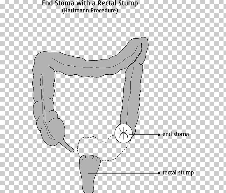 Colostomy Ileostomy Hartmann's Operation Surgery Fistula PNG, Clipart,  Free PNG Download