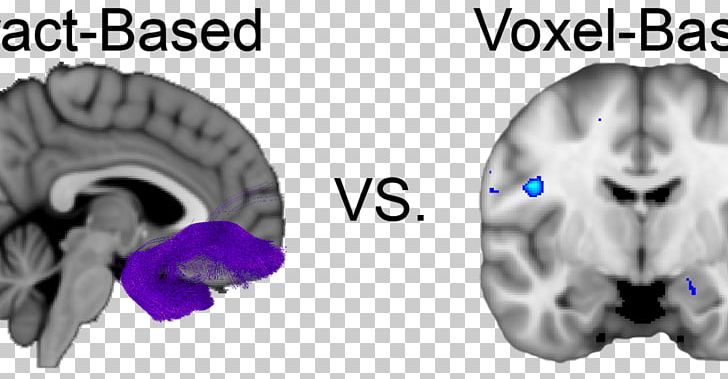 Diffusion MRI Brain Voxel-based Morphometry Magnetic Resonance Imaging White Matter PNG, Clipart, Amygdala, Basics, Bone, Brain, Diffusion Free PNG Download