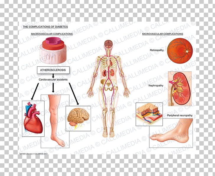 Complications Of Diabetes Mellitus Medicine Type 1 Diabetes PNG, Clipart, Abdomen, Arm, Complication, Diabetes Mellitus, Diabetes Mellitus Type 2 Free PNG Download