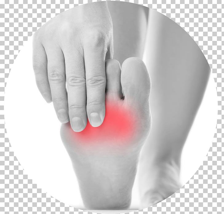 Morton's Neuroma Ball Podiatry Foot PNG, Clipart, Ball, Foot, Pain, Podiatry Free PNG Download