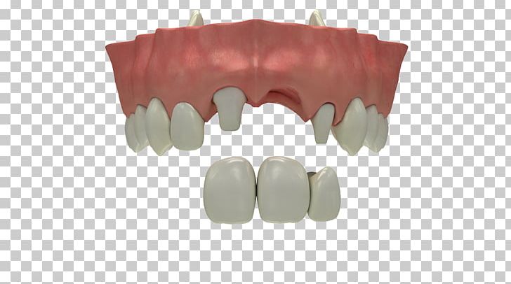 Tooth Loss Dental Implant Dentistry Human Tooth PNG, Clipart, Biting, Bridge, Dental Extraction, Dental Implant, Dentistry Free PNG Download