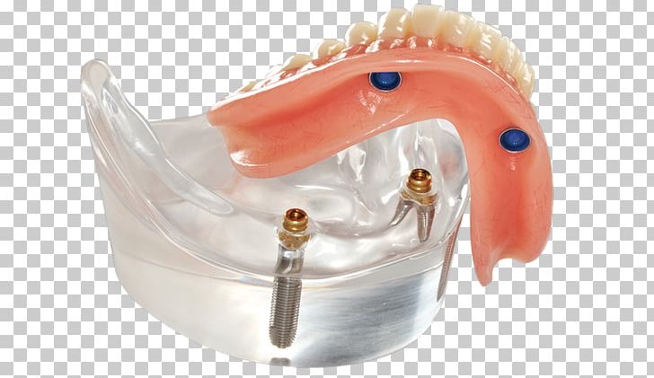 Dentures Dental Implant Dentistry Removable Partial Denture All-on-4 PNG, Clipart, Allon4, All On 4, Bridge, Clinic, Cosmetic Dentistry Free PNG Download