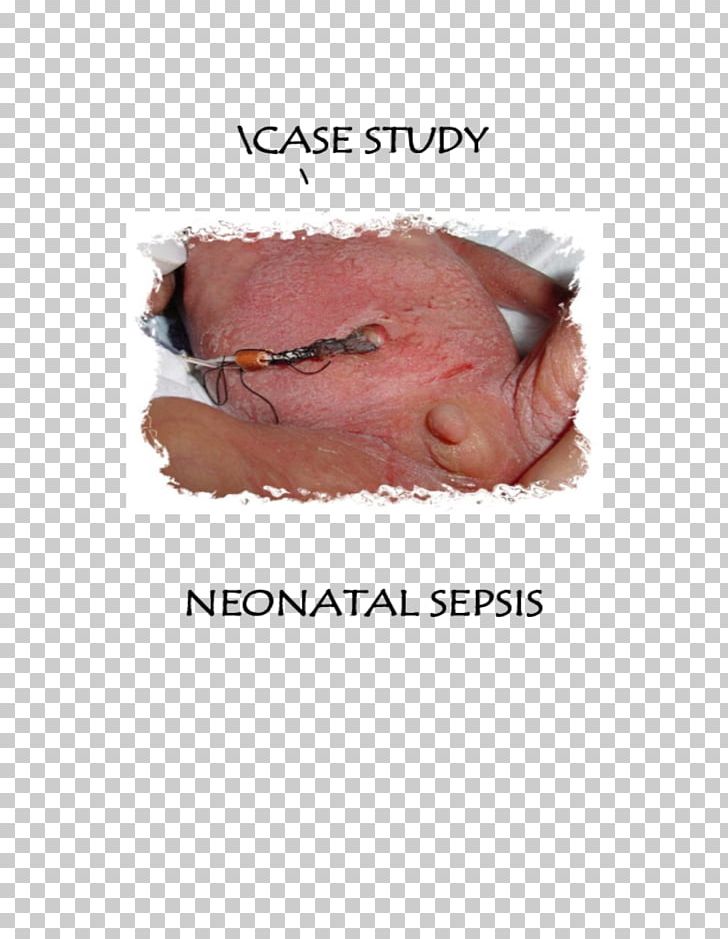 Neonatal Sepsis Infant Neonatology Preterm Birth PNG, Clipart, 2003 Ford Windstar, Adult, Child, Diagram, Ear Free PNG Download