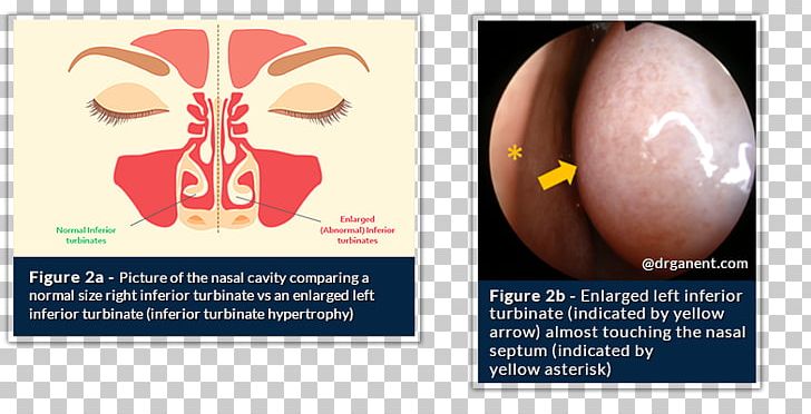 Nasal Concha Otorhinolaryngology Sinus Nose Septoplasty PNG, Clipart, Backwards, Cauterization, Cern, Deviated Nasal Septum, Finger Free PNG Download