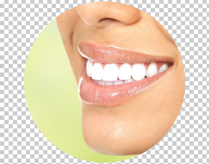 Tooth Whitening Cosmetic Dentistry PNG, Clipart, Cheek, Chin, Clear Aligners, Closeup, Cosmetic Dentistry Free PNG Download
