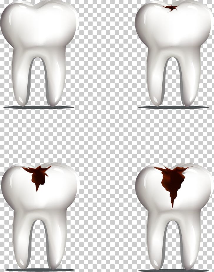 Tooth Decay Molar PNG, Clipart, Cartoon, Computer Icons, Decay, Decayed Tooth, Dentist Free PNG Download