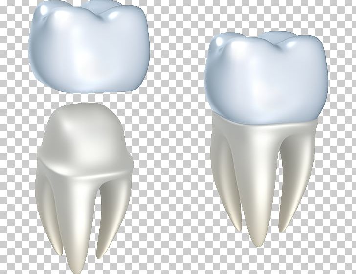 Crown Cosmetic Dentistry Dental Restoration PNG, Clipart, Bridge, Cadcam Dentistry, Cosmetic Dentistry, Crown, Deciduous Teeth Free PNG Download